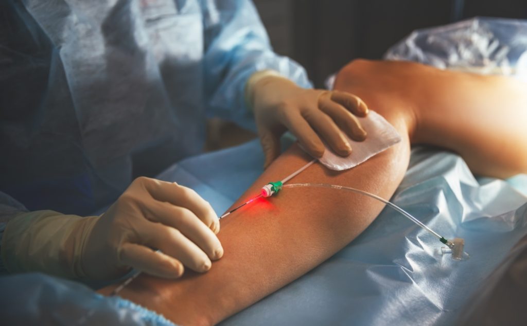 Varicose Veins Treatment in Kolkata
