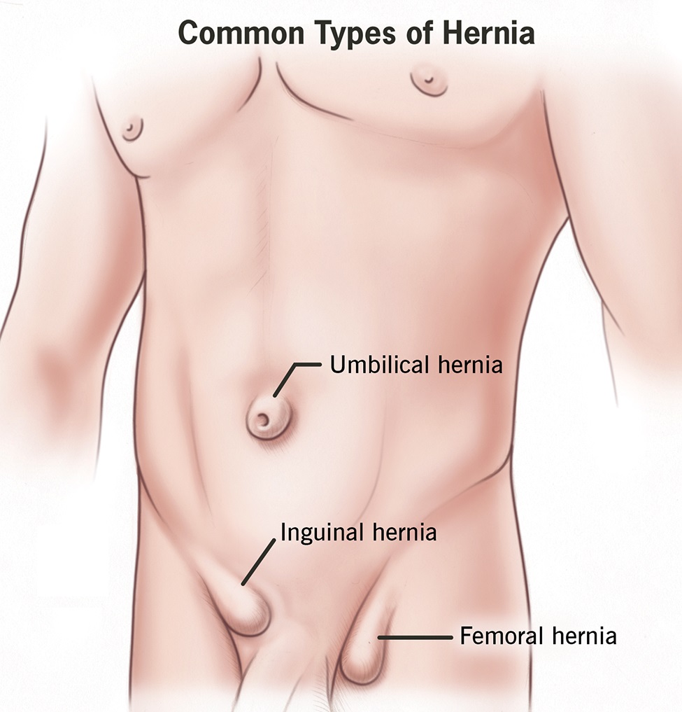 Best Hernia Specialist Surgeon