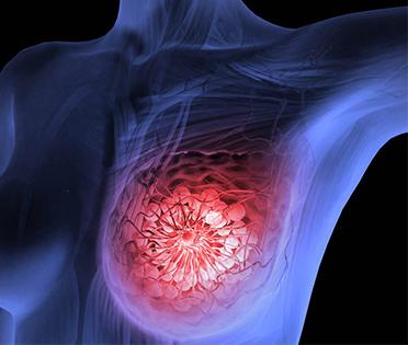 Breast Tumor Treatment In Kolkata