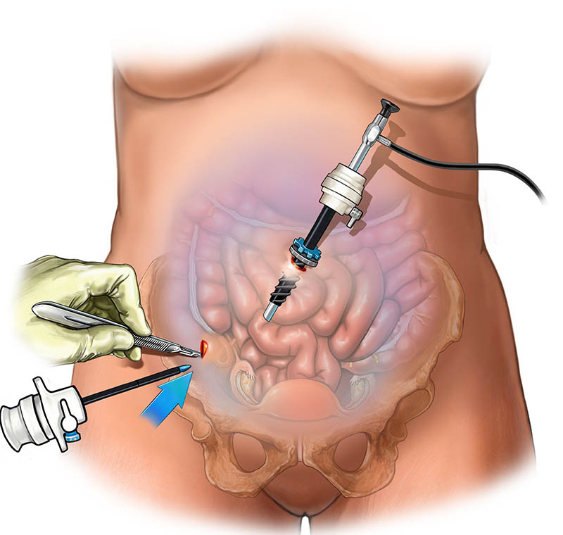 Laparoscopic Surgeon in Kolkata