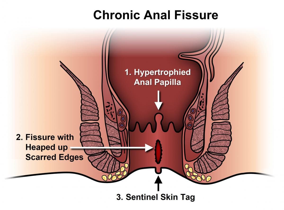 Fissure Doctor in Kolkata