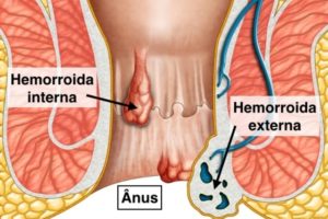 Stool Blood: Common Causes And Treatment