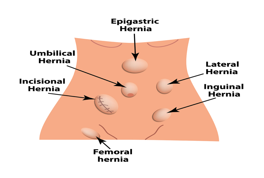 Female Hernia: Causes - Symptoms and Treatment