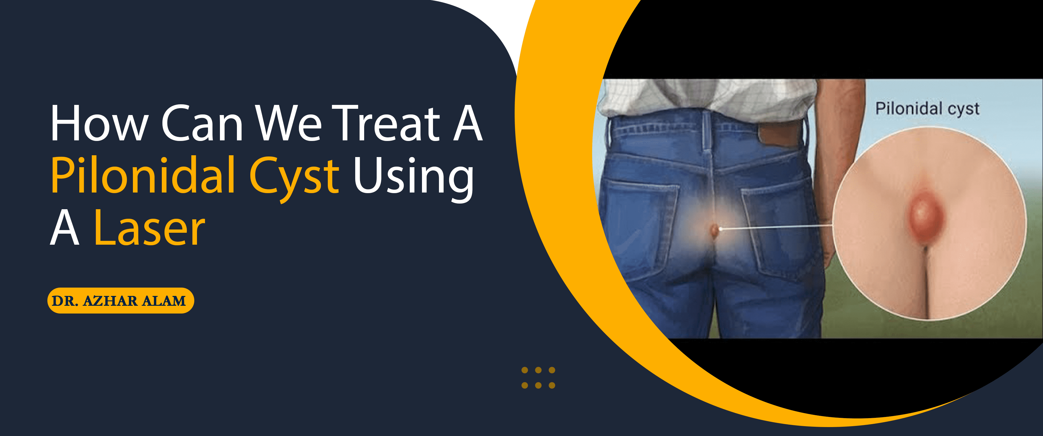 How can we treat a Pilonidal Cyst using a Laser?