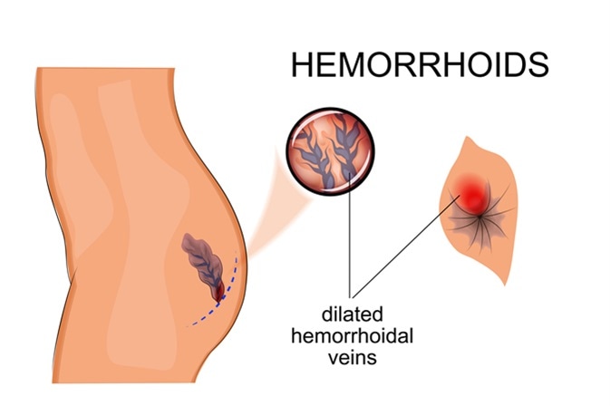 Difference between Piles and Anal Fistula