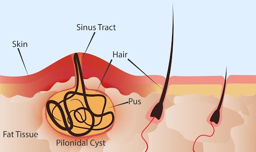 How can we treat a Pilonidal Cyst using a Laser?