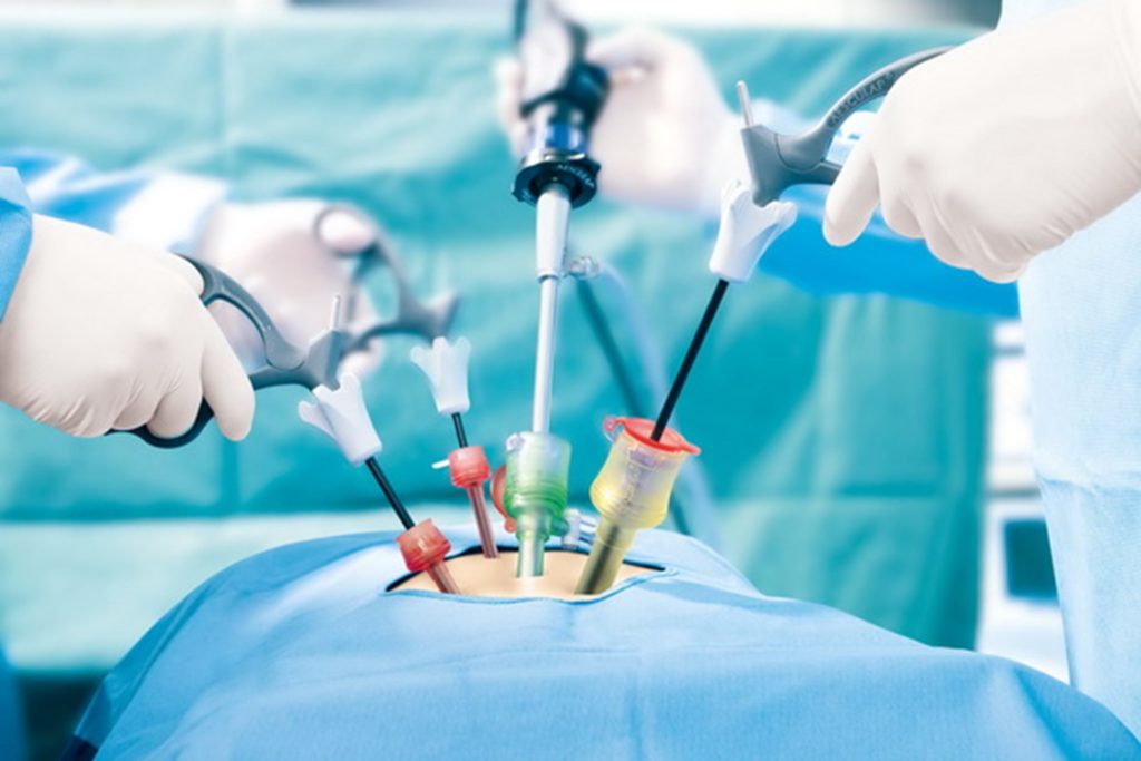 Laparoscopic Hernia Surgery