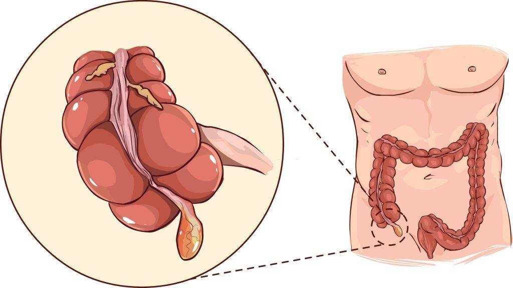 Appendicitis in Children