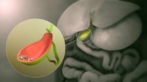 Gallbladder Stone Operation