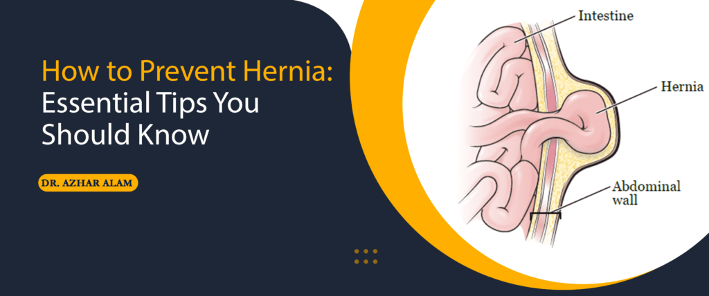 How to Prevent Hernia: Essential Tips You Should Know