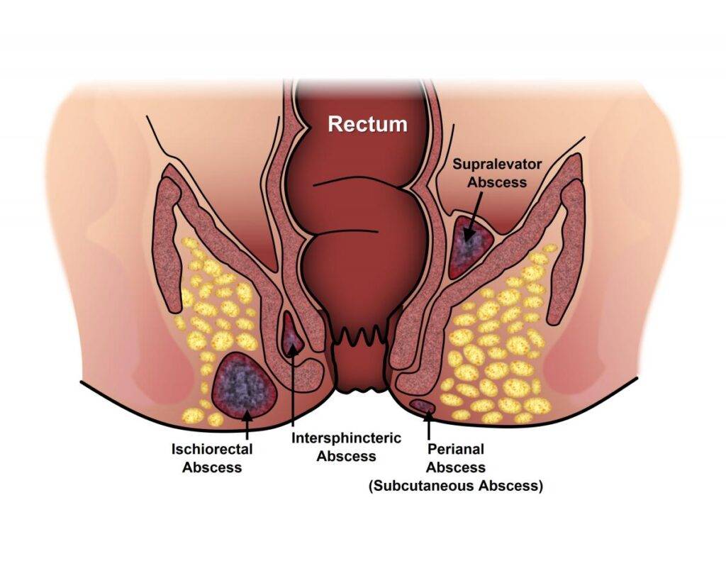 Signs And Symptoms Of Anal Fistula