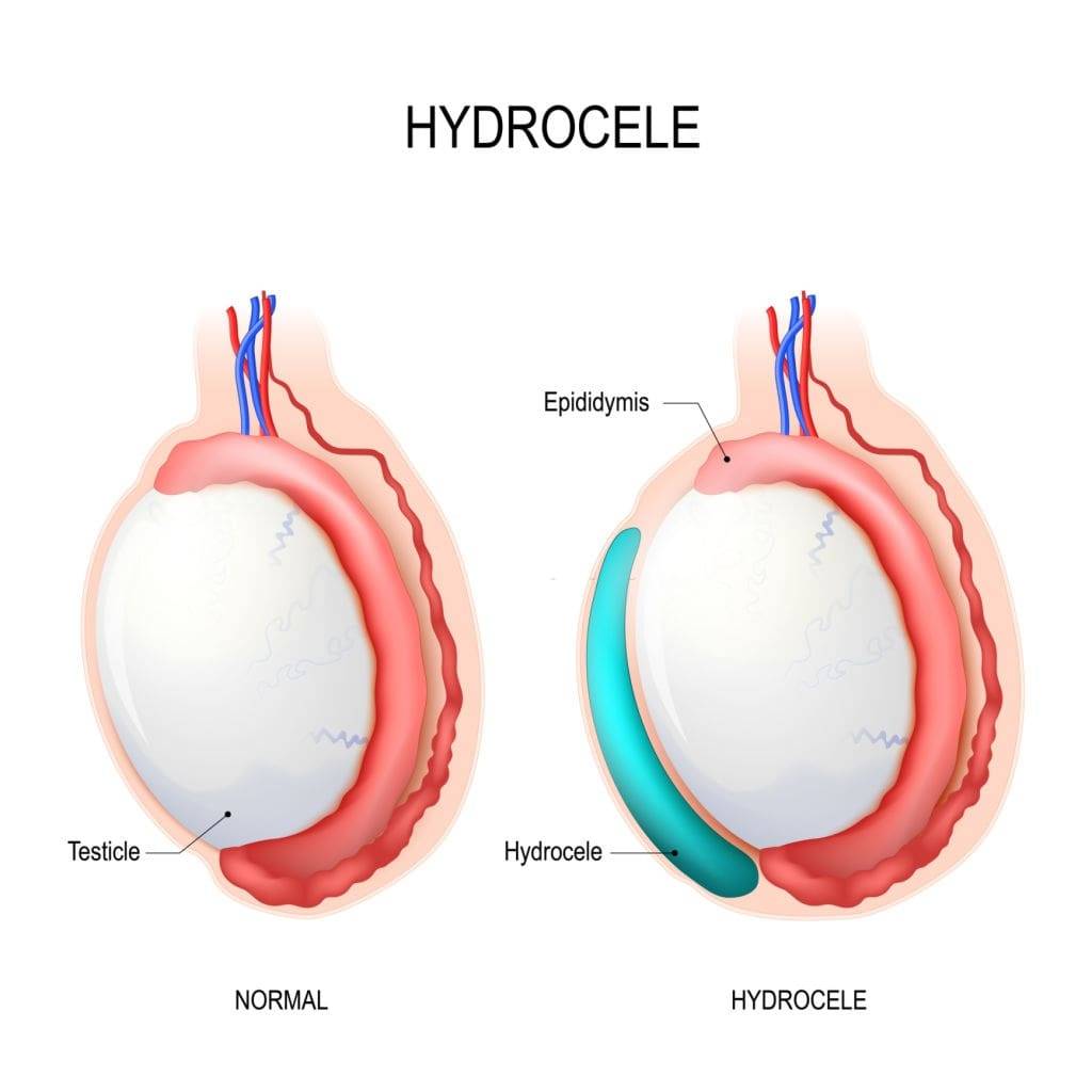 Hydrocele