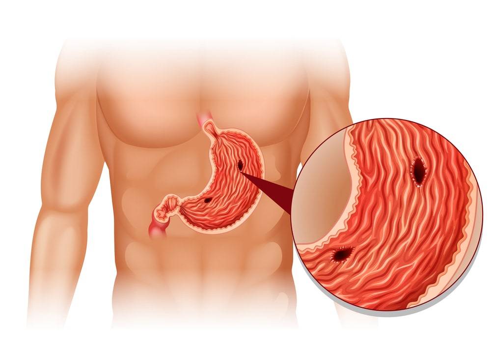 Upper Gastrointestinal Surgery