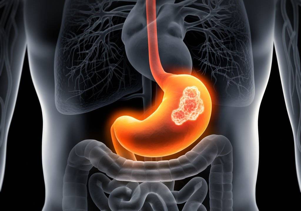 Upper Gastrointestinal