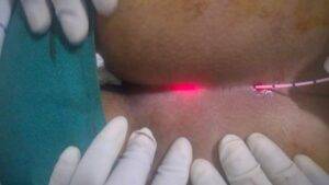 Laser Treatment for Pilonidal Sinus