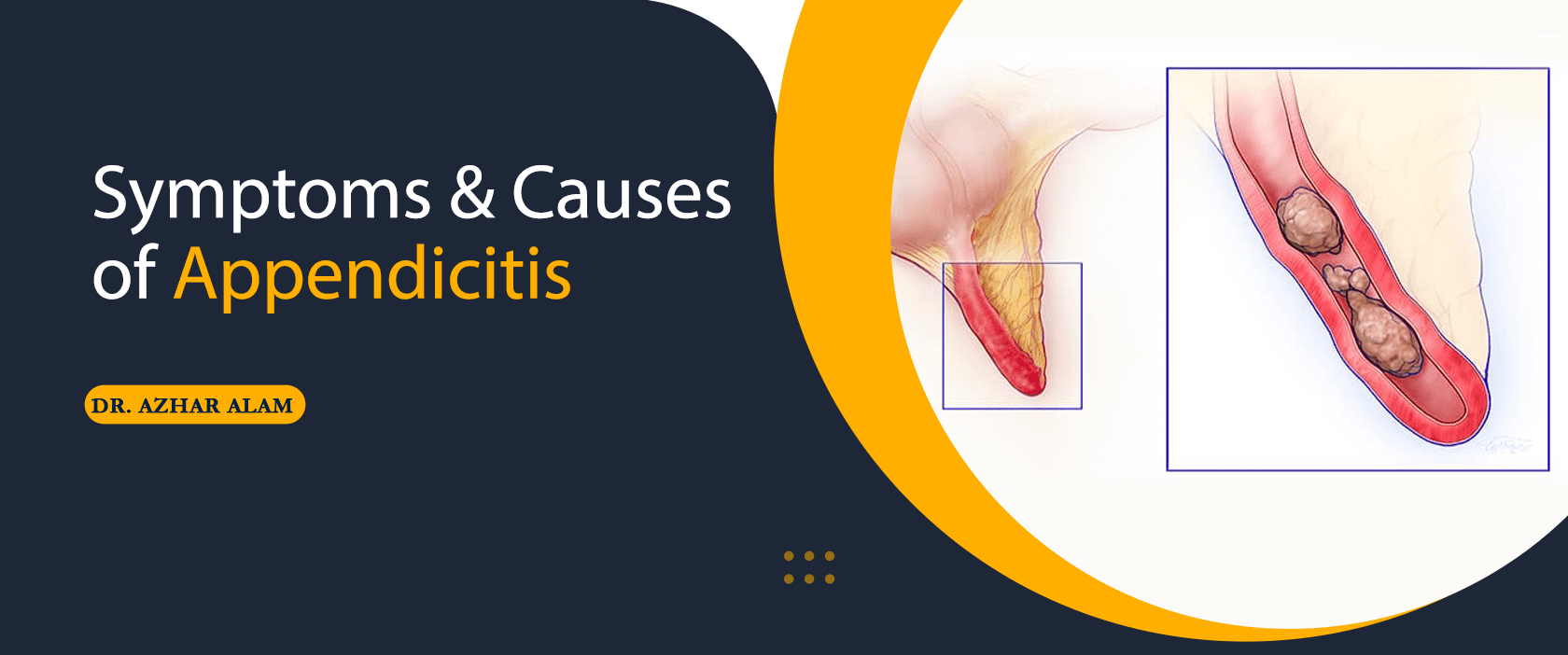 Symptoms & Causes of Appendicitis