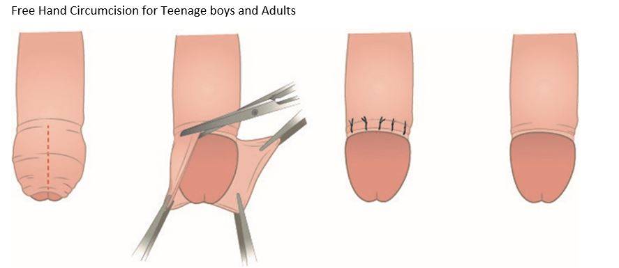 Adult Circumcision