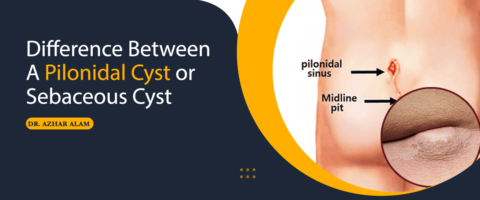 Pilonidal Cyst, Tailbone Cyst