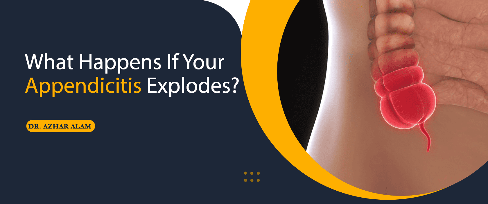 What Happens If Your appendix explodes