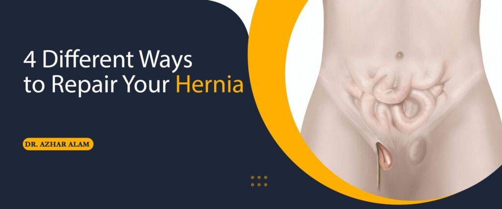 4 Different Ways to Repair Your Hernia