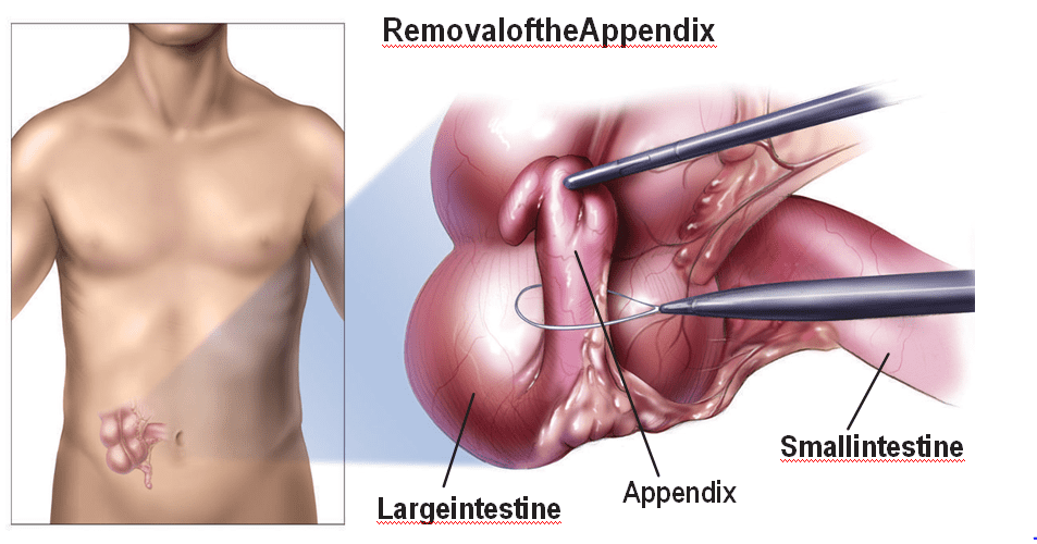 APPENDIX Removal