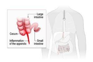 Appendicitis Treatment And Early Warning Signs