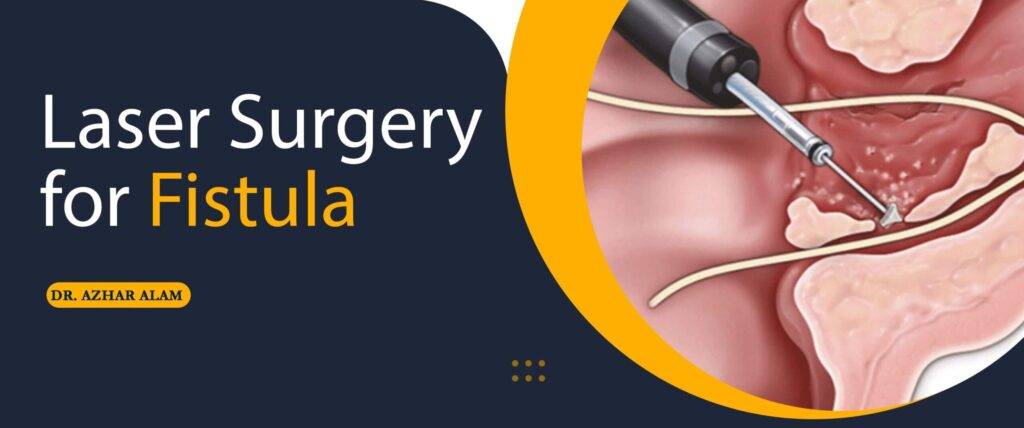 Laser Surgery for Fistula