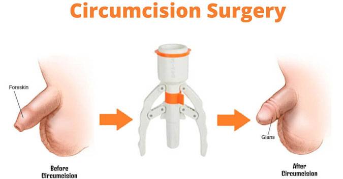 circumcision surgery