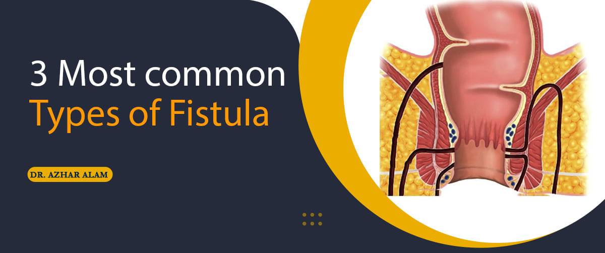 3 Most common types of Fistula