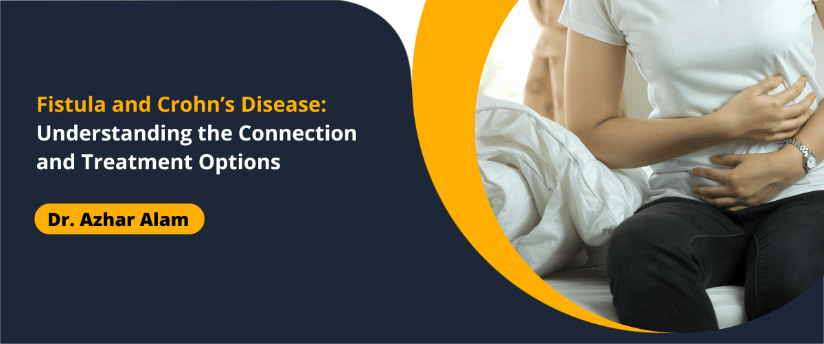 Fistula and Crohn’s Disease