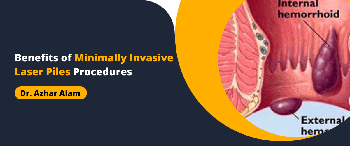 Benefits of Minimally Invasive Laser Piles Procedures