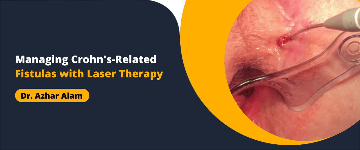 Managing Crohn's-Related Fistulas with Laser Therapy
