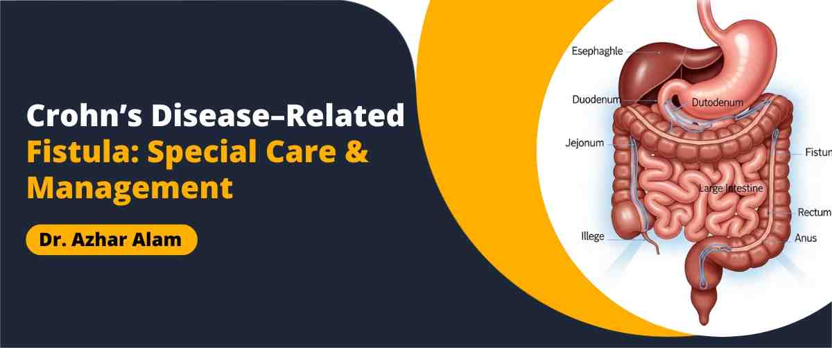 Crohn’s Disease – Related Fistula Special Care & Management