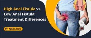 High Anal Fistula vs Low Anal Fistula