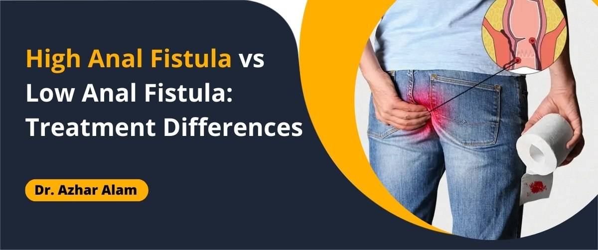 High Anal Fistula vs Low Anal Fistula