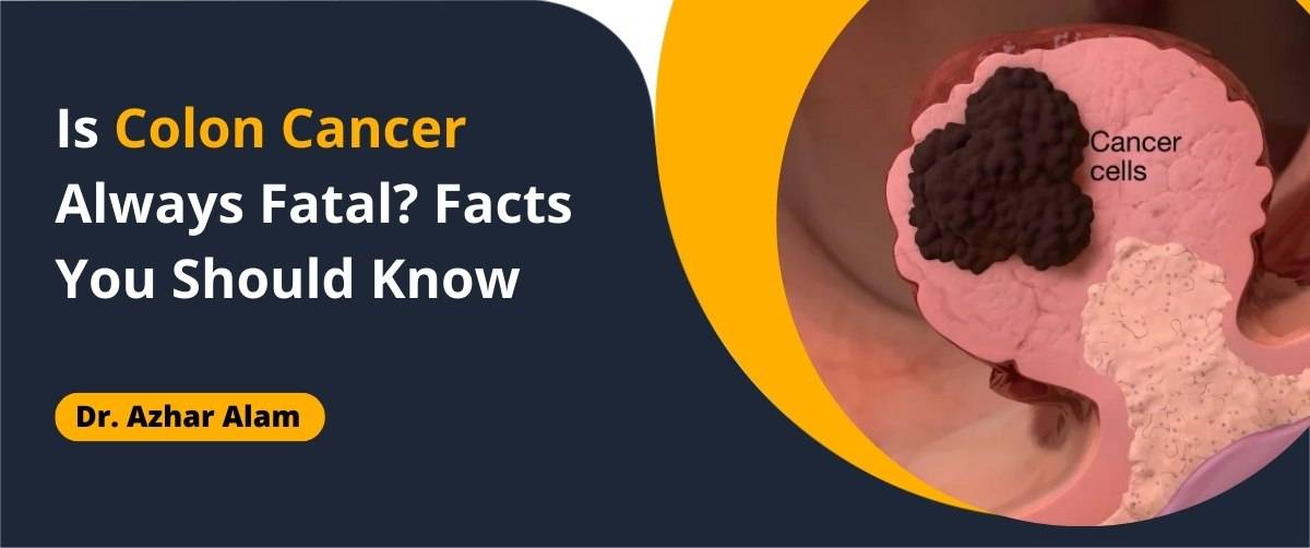 Is Colon Cancer Always Fatal