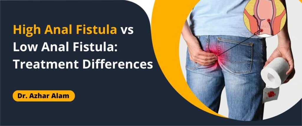 High anal fistula treatment